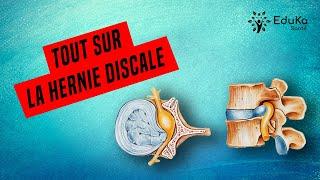 HERNIE DISCALE LOMBAIRE : TOUT SAVOIR SUR LES TRAITEMENTS, EXERCICES, CONSEILS