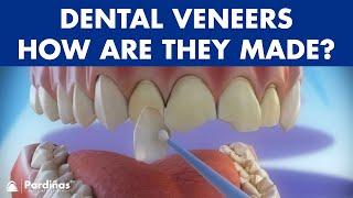 Veneers - How are they made? Preparation and placement of cosmetic dentistry veneers ©