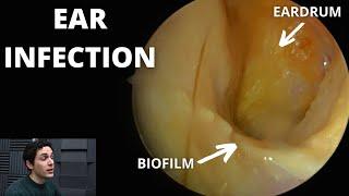 Ear Infections And The Problem Of Biofilm (Otitis Externa)