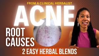 Heal Acne Naturally: What You Haven’t Been Told | Clinical Herbalist