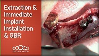 Extraction & Immediate Implant Installation & GBR - [Dr. Kim Yongjin]