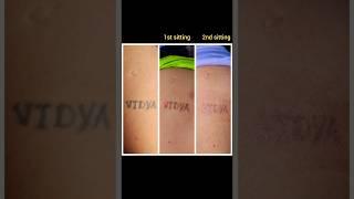 TATTOO REMOVAL RESULTS!!! #laser #trending #viral #beauty #shorts #short #satisfying #wow #clearskin