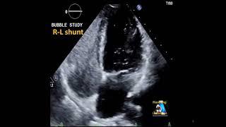 Bubble test (agitated saline) positive: R-L Shunt #shorts