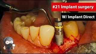 Narrated #21 Implant Surgery