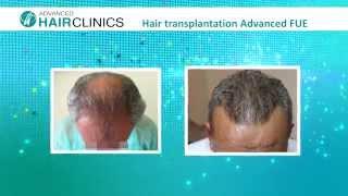 Hair Transplantation Before-After Video | Advanced Hair Clinics