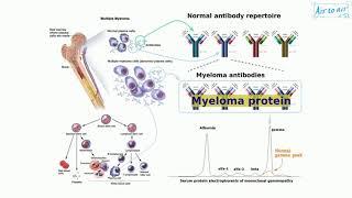 myeloma protein