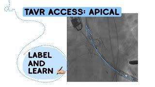 Identify TAVR access: APICAL!