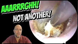 AARRGH! NOT ANOTHER! 307 #ear #earwax #earwaxremoval #foryou  #asmr #asmrearwax #satisfying