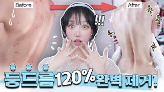 ️전후사진 확인️등드름 가드름 120% 없애기!  바디트러블 원인부터 완벽한 제거법!!