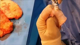 AUA2019 V05-01 Complete demonstration of the radial artery forearm phalloplasty formation