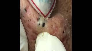 acne old aged blackheads removal