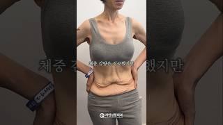 다이어트 성공이 불러온 예상치 못한 결과 | 기린성형외과