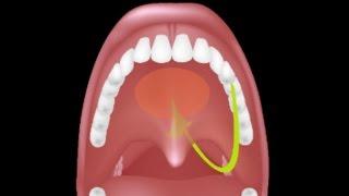 Adenoid Removal Surgery (Adenoidectomy)