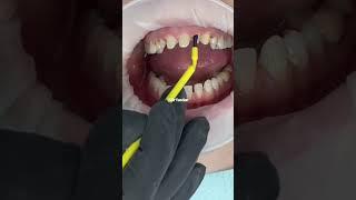 Porcelain crowns front teeth | smile makeover before and after | Dr. Yazdan | smile makeover veneers