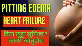 Pitting Edema I Pitting Edema causes