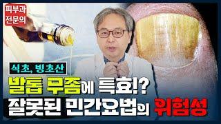 발톱무좀 민간요법 정말로 효과가 있을까요? #발톱무좀 #무좀 #손발톱무좀