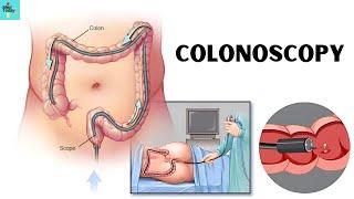 What You Need to Know Before Scheduling a Colonoscopy?