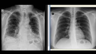 Chest Xray : Idiopathic pulmonary fibrosis ( by hammadshams)