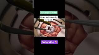 HOW A BRAIN TUMOR IS REMOVED #shorts #tiktok #viral