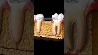 Мост после ортодонтического лечения #vatech #dentist