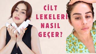 YAZIN LEKE Bakımı | Cilt lekeleri için kullanılması gereken içerikler & Örnek Rutin