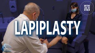 Lapiplasty Procedure for Bunion Repair