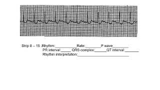 AV blocks, ventricular, and pacemaker homework review video