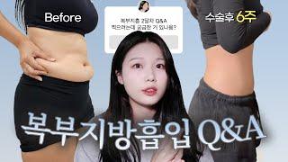 복부 지방흡입 2개월차 후기️ Q&A 총정리, 가격, 고통, 효과, 큐앤에이까지!!