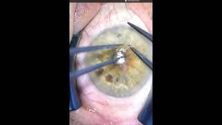 Post pterygium corneal scar removal