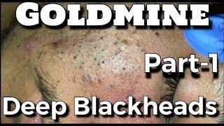 Goldmine of Big Deep Blackheads Part-1