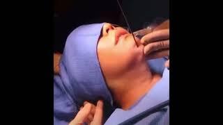 from the plastic surgeon’s operating room showing the procedure for liposuction of this neck area