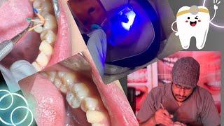 Molar Composite filling step by step #dental#viral#youtube#umair toothfairy@Umairazeem8553