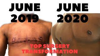 FTM Transgender: 1 Year Post Op Top Surgery *Graphic*