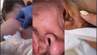 Popping Huge Blackheads and Pimple Popping - Best Pimple Popping Videos 23