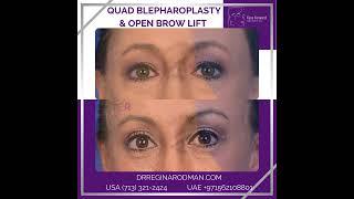 Quad Bleph and Brow Lift