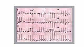 Guidelines For The Management of Patients with  Supraventricular Tachycardia    Dr  Azza A Katta