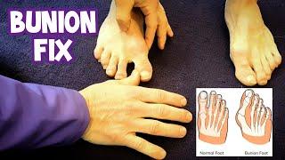 How to MASSAGE BUNIONS | Treatment Without Surgery