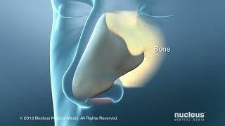 Deviated Septum Surgery (Septoplasty) for Difficulty in Breathing