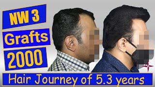 Hair Transplantation Result in 5.3 Year, 2000 Grafts, Grade 3 @Eugenix by Drs Sethi & Bansal