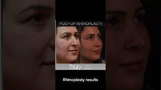 Before and after Rhinoplasty - Dr Guncel Ozturk