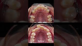 Braces proces - tooth extraction fix overbite teeth