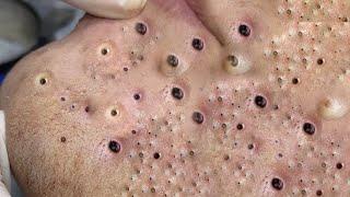 Big Cystic Acne Blackheads Extraction Blackheads & Milia, Whiteheads Removal Pimple Popping #009