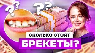 СОВЕТЫ СТОМАТОЛОГА: КАКИЕ БРЕКЕТЫ ВЫБРАТЬ? ЦЕНА - КАЧЕСТВО