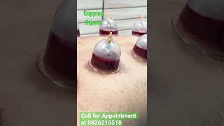 Cupping therapy | Hijama therapy treatment for body Detox: How it works