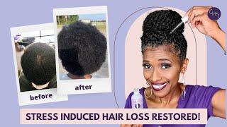 Hair Loss RESTORED After Stress