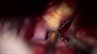 Microsurgical Clipping of a Wide-Necked Anterior Communicating Artery Aneurysm