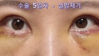 상안검하안검수술전후/회복과정/수술후기/쌍꺼풀/눈밑지방재배치/붓기/멍