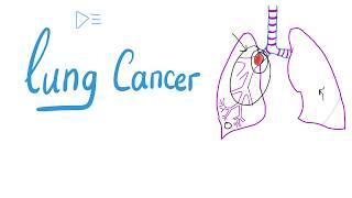 Lung Cancer - Bronchogenic Carcinoma - The most COMPREHENSIVE Explanation