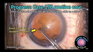 CataractCoach™ 2172: progress case 170 routine case