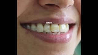 Smile Makeover for Fluorosis and Overlapping Teeth by Dr Trivikram Rao